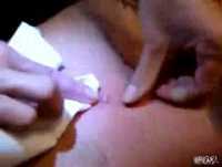 Biggest Pimple In The World