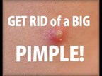 How to Get Rid of a BIG Pimple Fast!