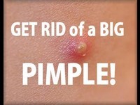 How to Get Rid of a BIG Pimple Fast!